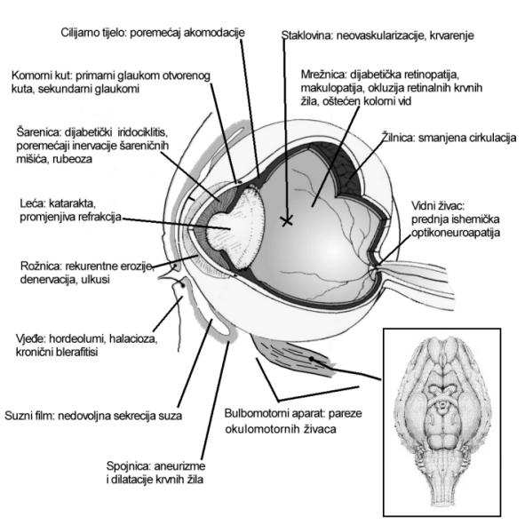 Diabetes_i_oko.jpg (135497 bytes)