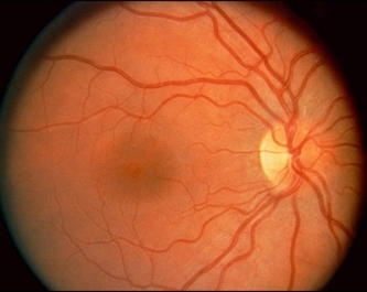 Normalni fundus.jpg (60197 bytes)