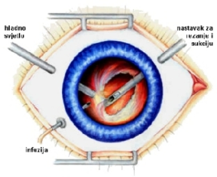 Vitrektomija-sprijeda.jpg (48801 bytes)